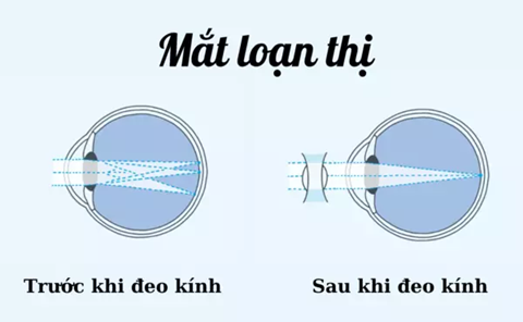 Loạn thị bẩm sinh, nhận biết, phòng ngừa và điều trị hiệu quả cho trẻ